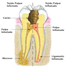 endodoncia-madrid