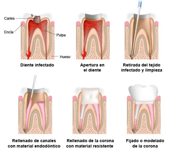 endodoncia-madrid