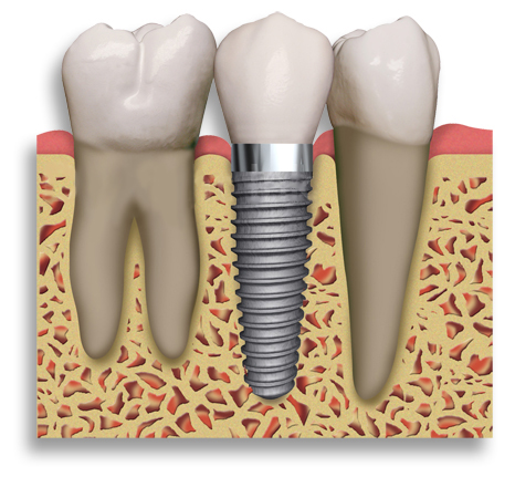 implantes-dentales-madrid